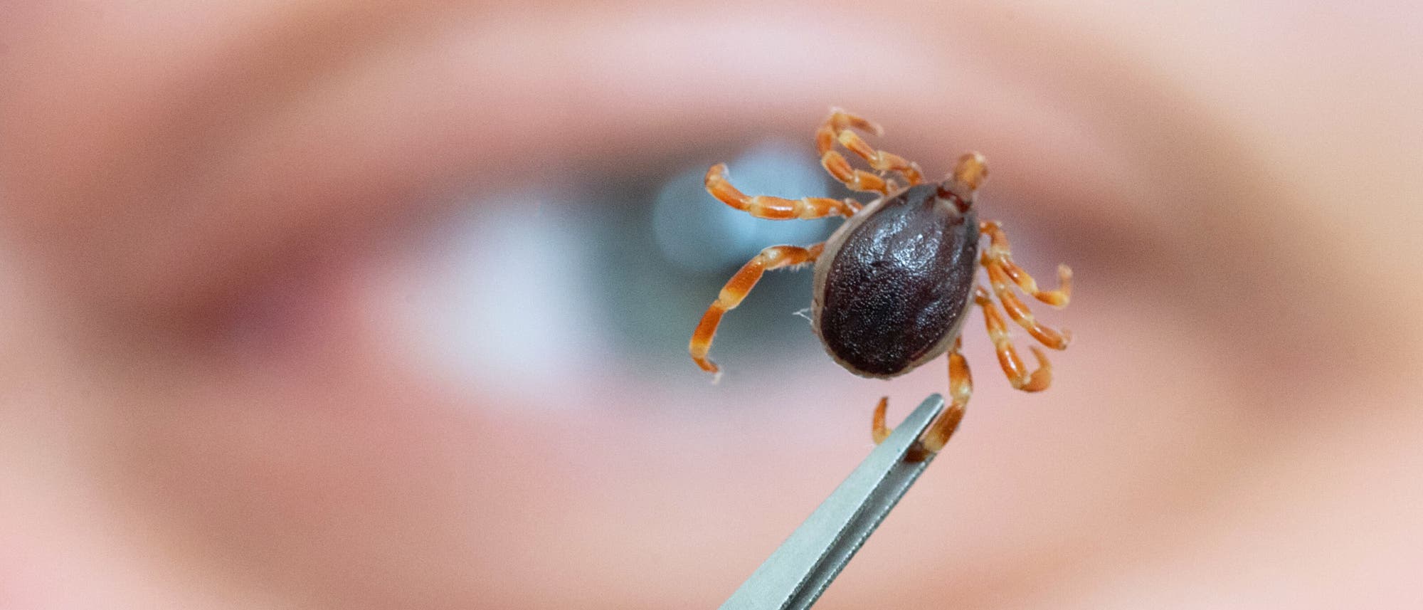 Eine Hyalomma-Zecke, die man an ihrer Größe und den gestreiften Beinen erkennt, wird mit einer Pinzette gehalten, während im Hintergrund unscharf ein menschliches Auge zu sehen ist. Eine Hyalomma-Zecke, die man an ihrer Größe und den gestreiften Beinen erkennt, wird mit einer Pinzette gehalten, während im Hintergrund unscharf ein menschliches Auge zu sehen ist.