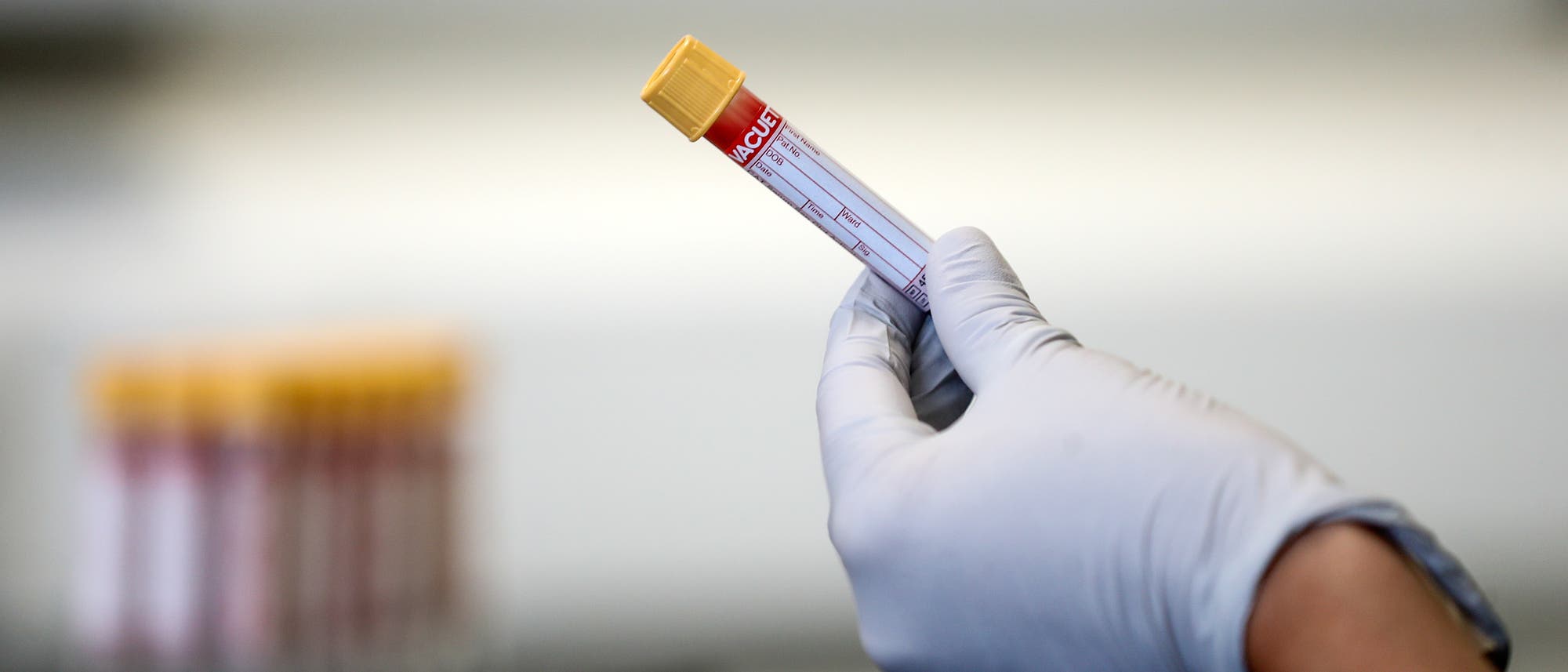 Röhrchen mit Blut für einen HIV-Test