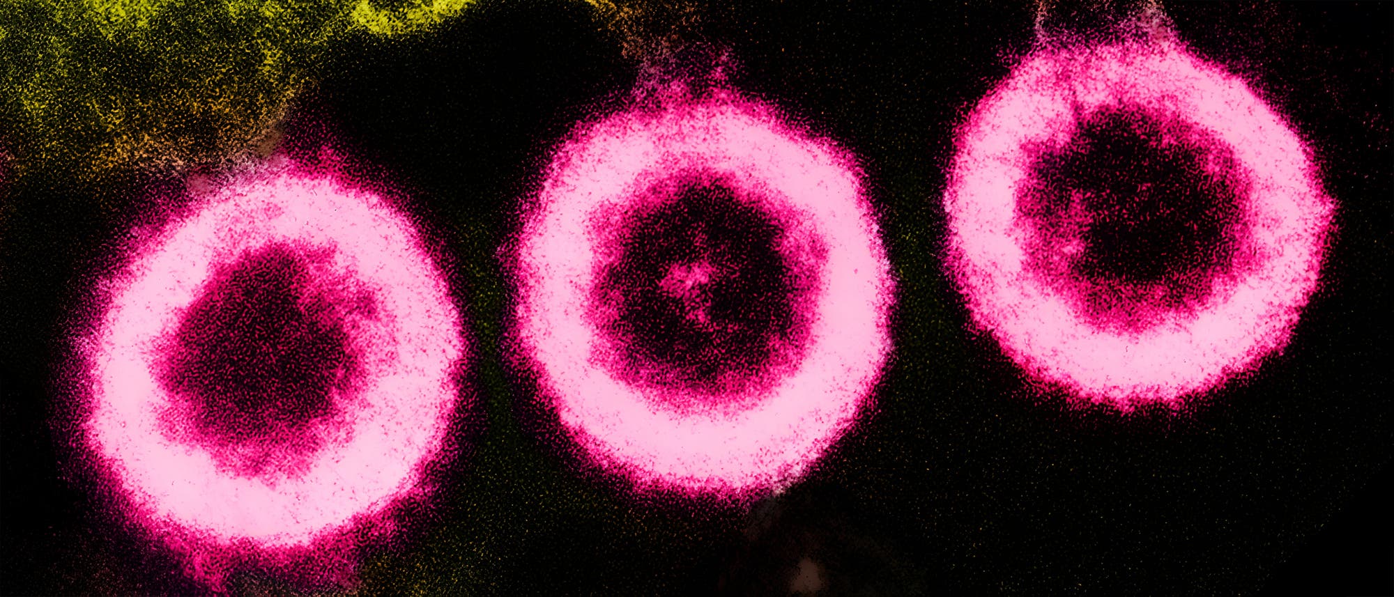 Siebter Fall von HIV-Heilung zeigt Chancen für neue Therapien auf