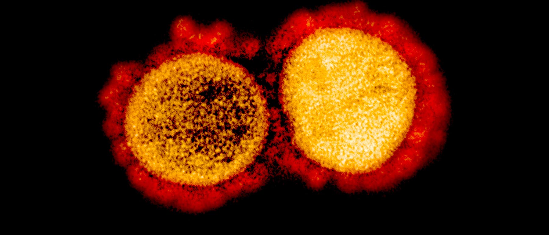 Transmissionenelektronenmikroskopische Aufnahme Sars-CoV-2. Man sieht sehr gut die Krone aus Spike-Proteinen um die Viruspartikel.