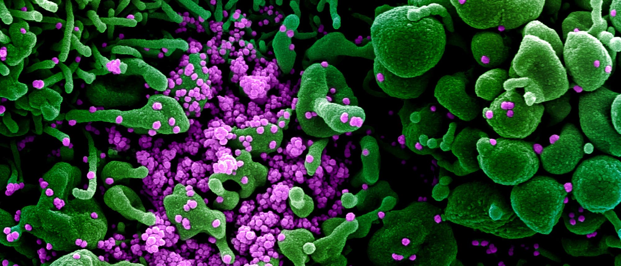 Eine rasterelektronenmikroskopische Aufnahme zeigt eine mit Sars-Cov-2-Partikeln (lila) infizierte Zelle (grün).