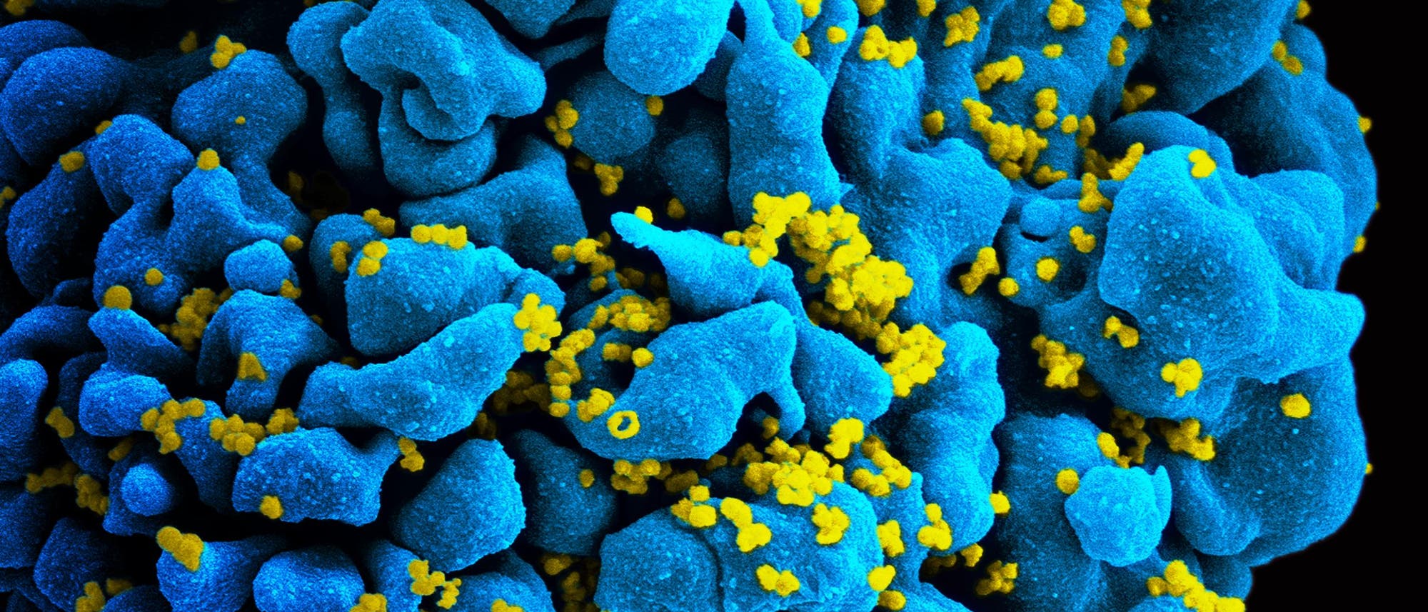 Mit HIV-1 infizierte T-Zelle