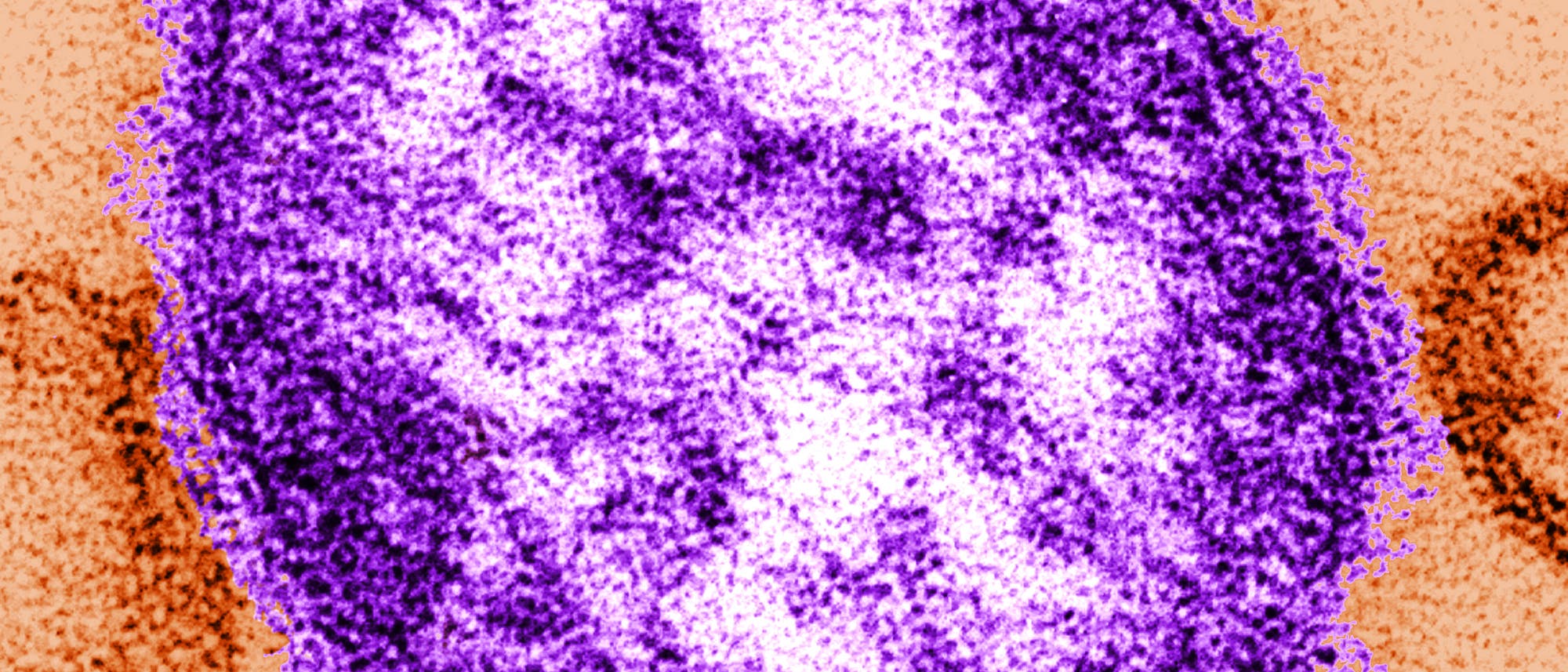 Eine undatierte Abbildung, die mit Hilfe eines Transmissionselektronenmikroskops gemacht wurde, zeigt Teile eines Masernvirus lila eingefärbt. 