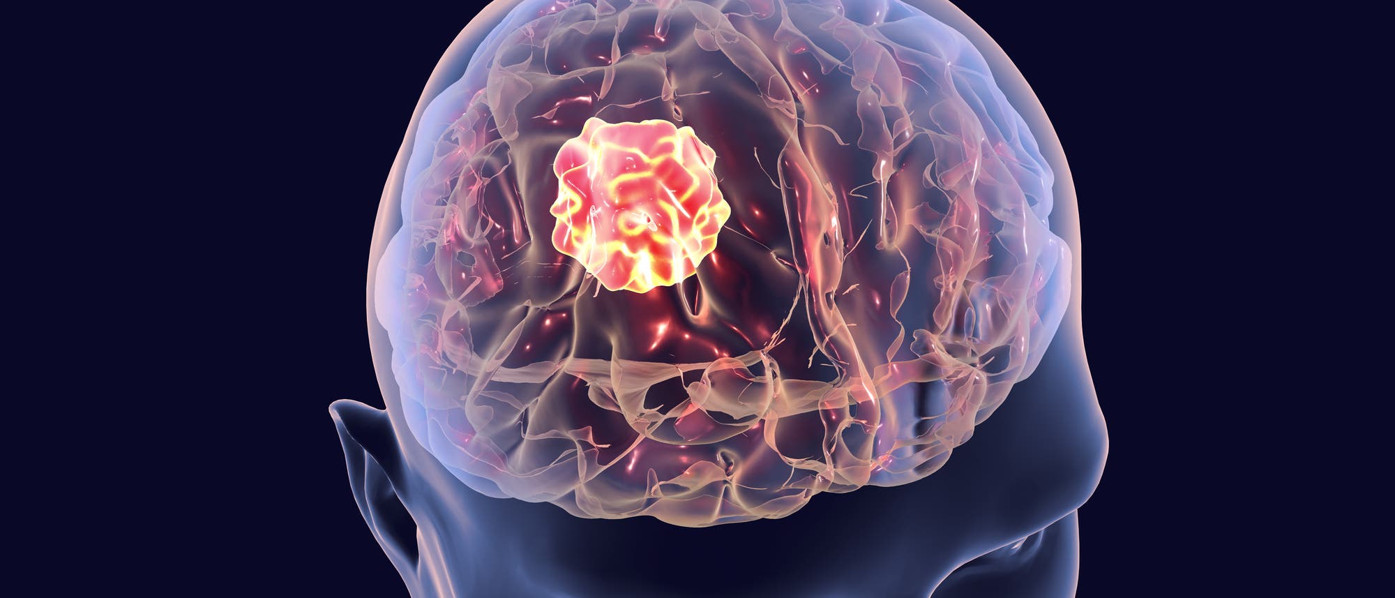 Illustration eines halbtransparenten Kopfs mit einem roten Tumor drin.