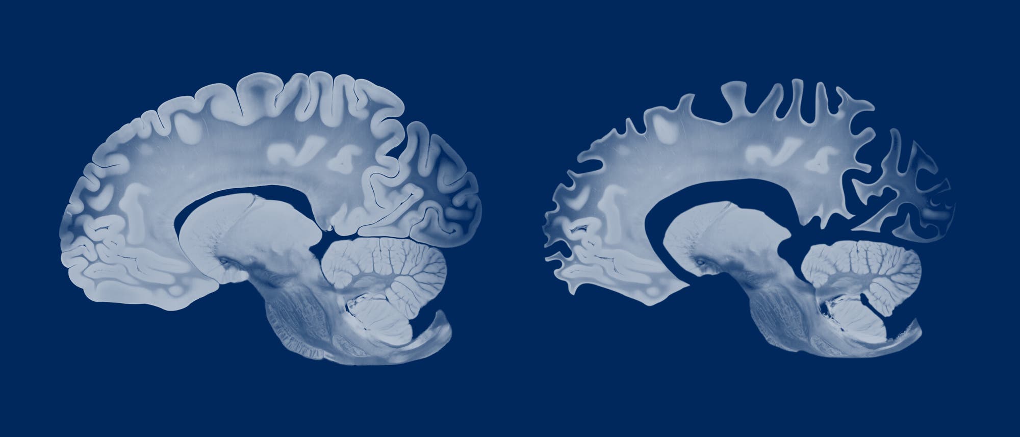 Zwei Querschnitte von Gehirnen, die die Abnahme des Hirnvolumens beim Auftreten von Alzheimer zeigen, links das Gehirn eines Gesunden und rechts das eines Erkrankten. Die Darstellung ist in Blautönen gehalten, um die Details der Gehirnanatomie zu betonen.
