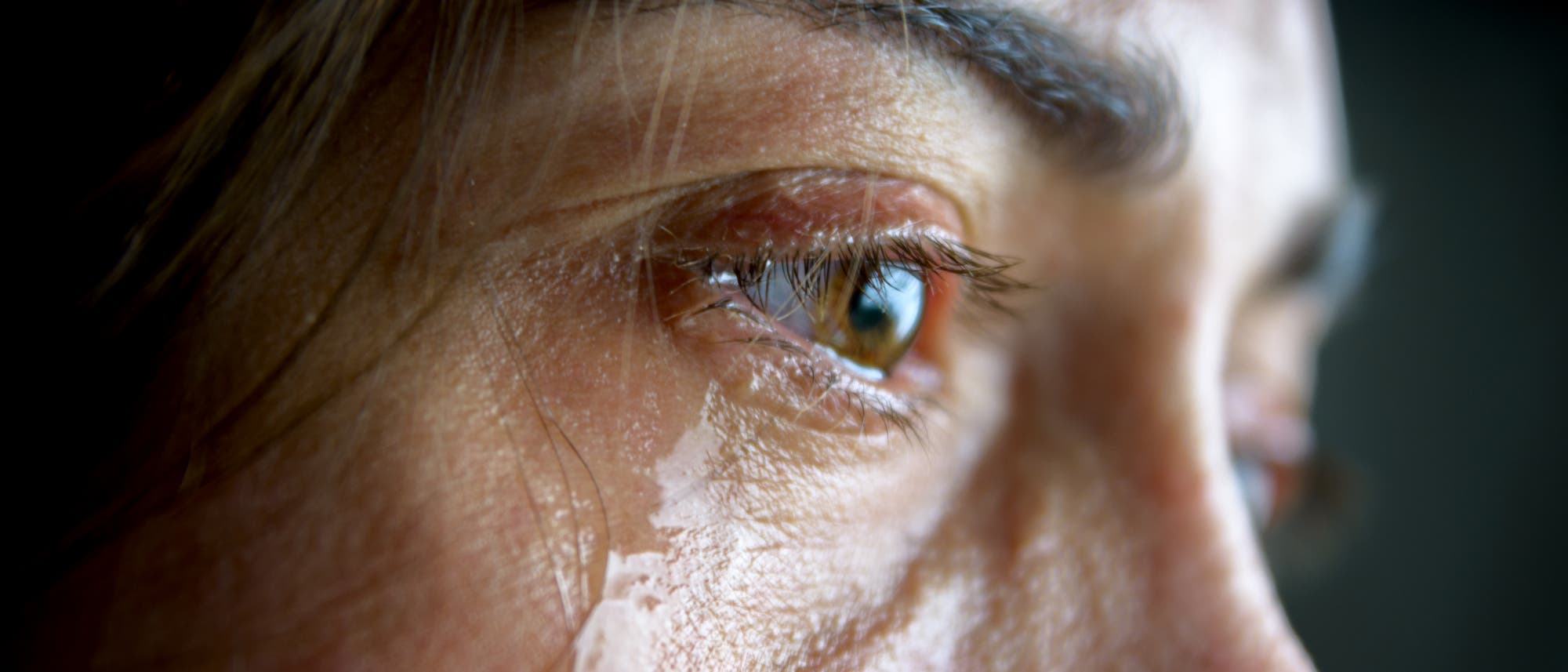 Ein Schlaganfall kann eine wahre Tränenflut auslösen. Allerdings ist das Phänomen so selten, dass Ärzte in vielen Fällen eine falsche Diagnose stellen.