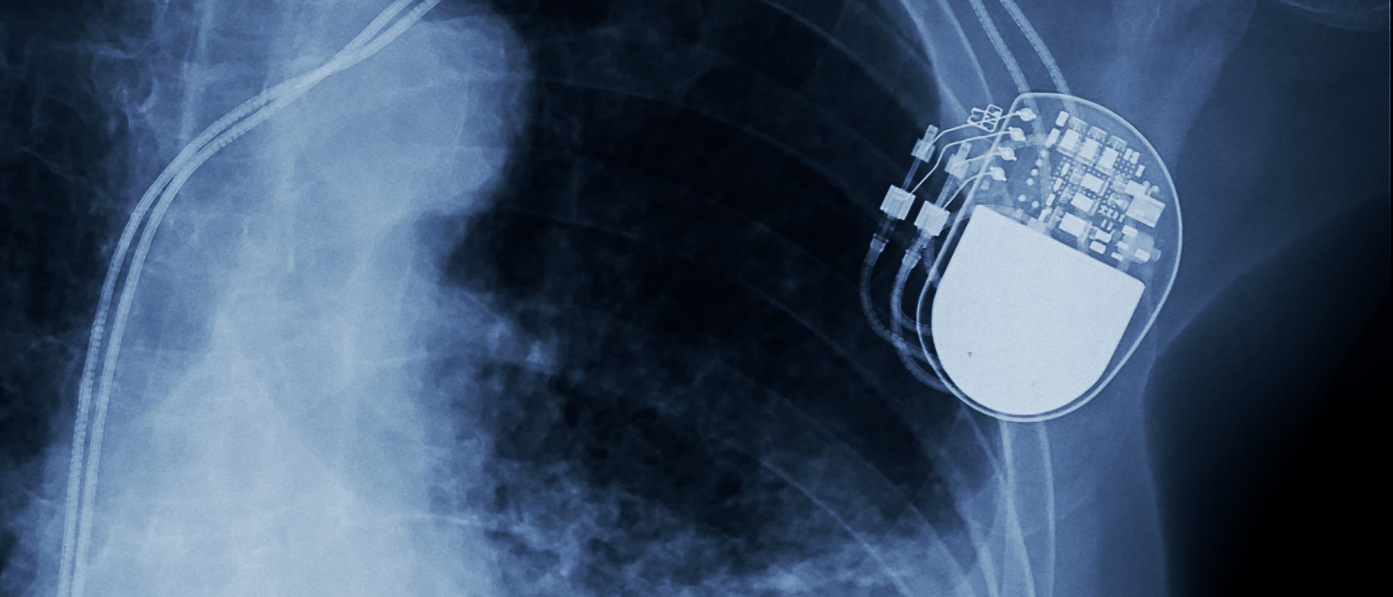 Herzschrittmacher im Röntgenbild