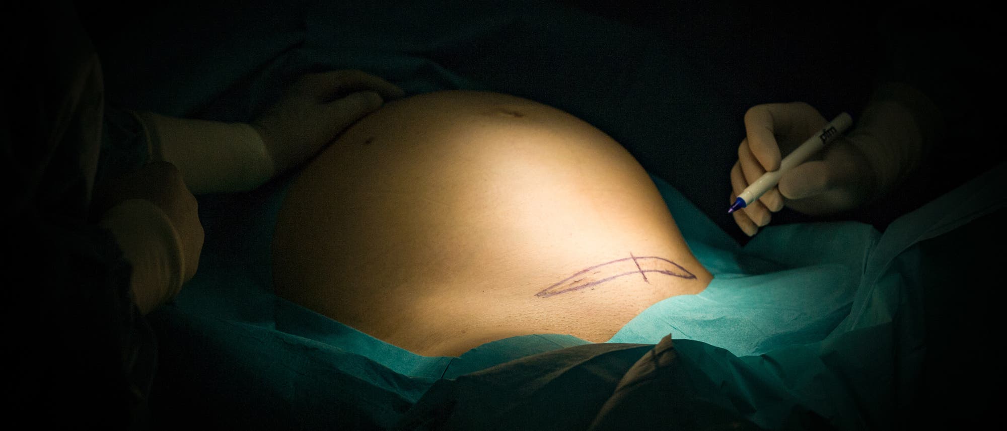 Eine schwangere Person liegt auf einem Operationstisch, der Bauch ist mit einem chirurgischen Tuch bedeckt. Zwei Hände in OP-Handschuhen sind sichtbar; eine hält einen Stift und zeichnet eine Markierung auf den Bauch. Die Szene ist in gedämpftem Licht gehalten, das den Bauch hervorhebt. Eine schwangere Person liegt auf einem Operationstisch, der Bauch ist mit einem chirurgischen Tuch bedeckt. Zwei Hände in OP-Handschuhen sind sichtbar; eine hält einen Stift und zeichnet eine Markierung auf den Bauch. Die Szene ist in gedämpftem Licht gehalten, das den Bauch hervorhebt.