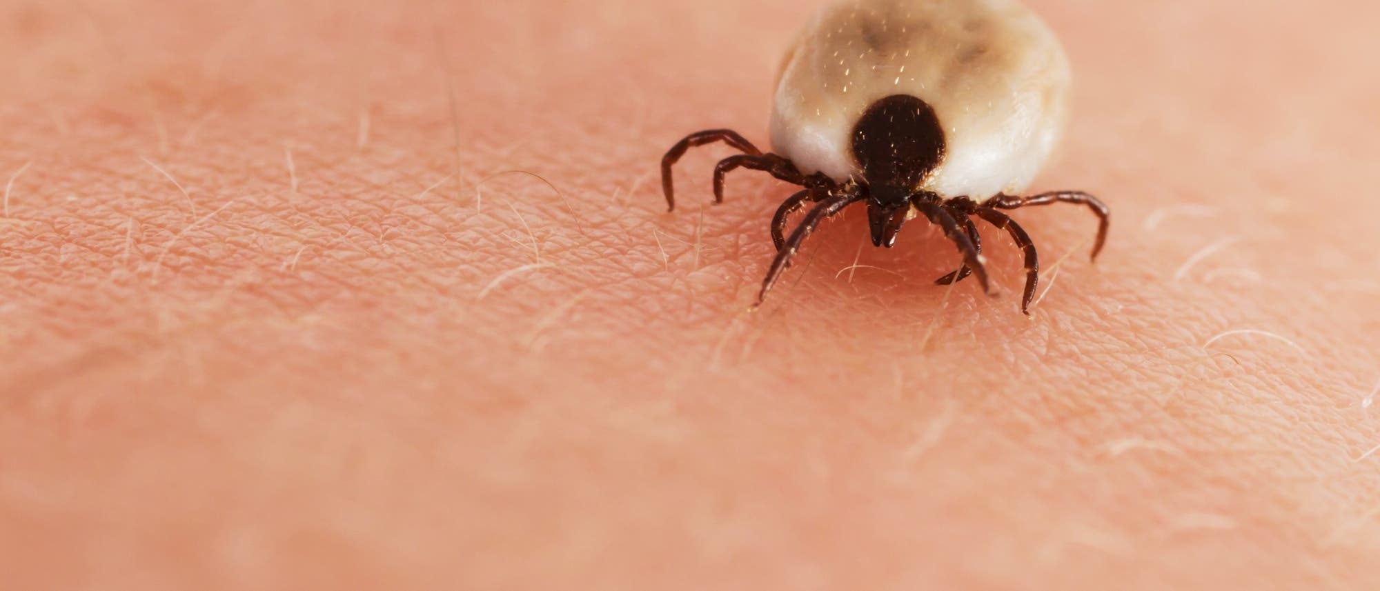 Eine vollgesogene Zecke krabbelt über nackte Haut. Eine vollgesogene Zecke krabbelt über nackte Haut.