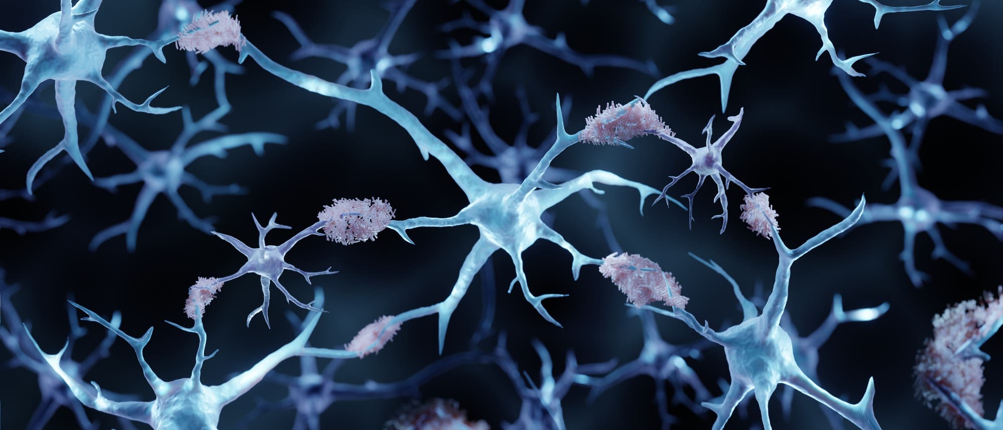 Illustration mit Nervenzellen, an denen sich verklumpte, stäbchenförmige Plaques abgelagert haben