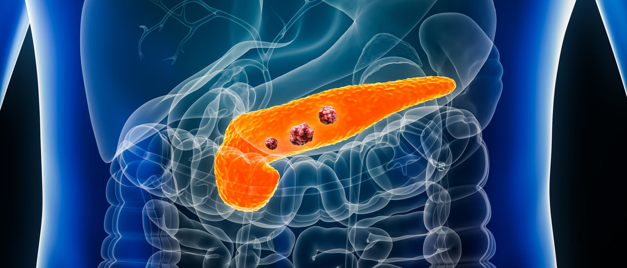 Eine medizinische Illustration zeigt die menschliche Bauchspeicheldrüse in leuchtendem Orange, eingebettet im Verdauungssystem. In der Bauchspeicheldrüse sind mehrere dunkle Tumoren zu sehen. Der Hintergrund zeigt schematisch den Oberkörper mit transparenten Darstellungen der umliegenden Organe und Blutgefäße. Die Illustration dient der Veranschaulichung von Pankreaserkrankungen. Eine medizinische Illustration zeigt die menschliche Bauchspeicheldrüse in leuchtendem Orange, eingebettet im Verdauungssystem. In der Bauchspeicheldrüse sind mehrere dunkle Tumoren zu sehen. Der Hintergrund zeigt schematisch den Oberkörper mit transparenten Darstellungen der umliegenden Organe und Blutgefäße. Die Illustration dient der Veranschaulichung von Pankreaserkrankungen.
