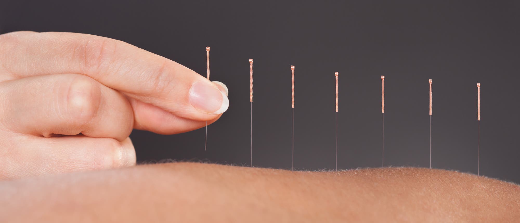 Nahaufnahme einer Hand, die Akupunkturnadeln in gerader Linie auf Haut setzt.