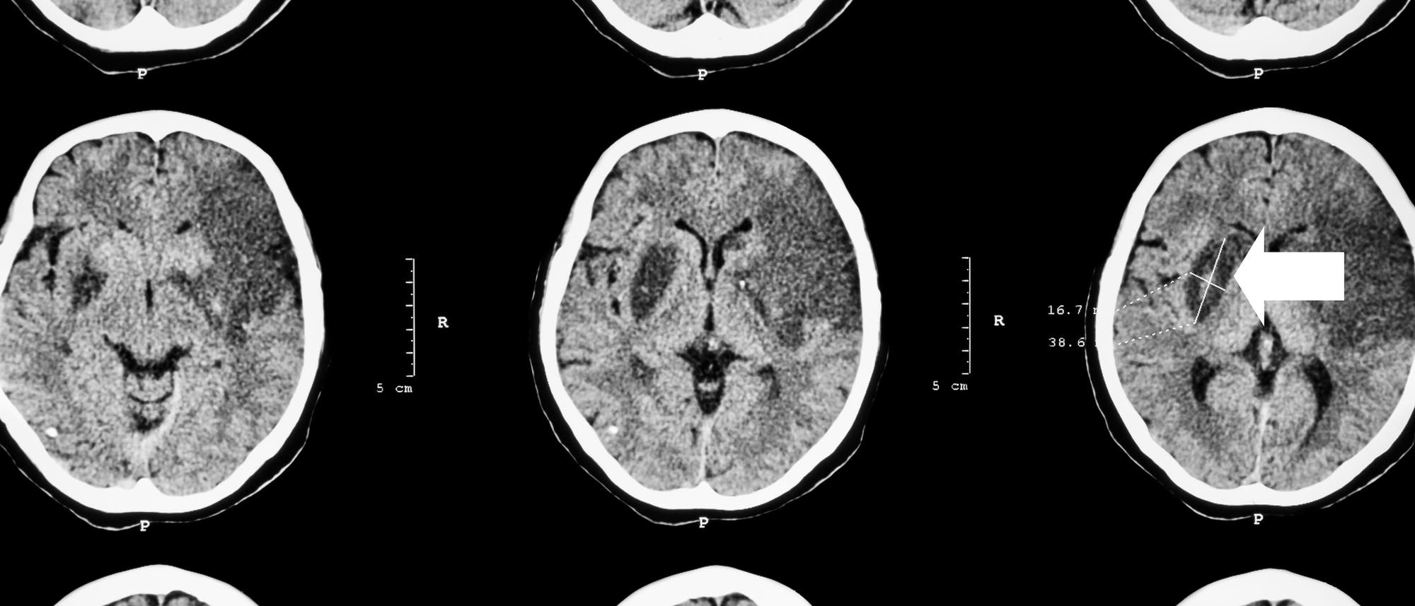 Ischämischer Schlaganfall im CT-Scan