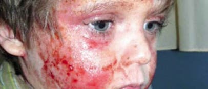Kinder mit Neurodermitis haben eine so trockene Haut, dass diese schon auf kleinste Reizungen wie Schweiß, Seife oder scheuernde Kleidung mit Entzündungen reagiert.
