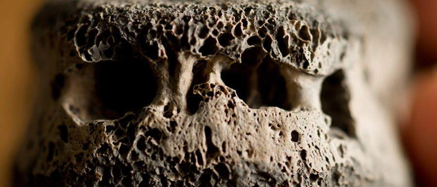 Neuzeitliches Krankheitsleiden steckte schon in alten Knochen  