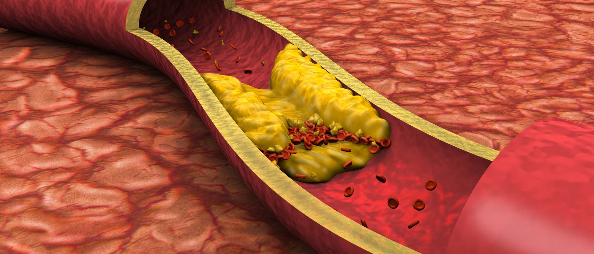 Hohe Cholesterinspiegel verursachen Arteriosklerose - oder?