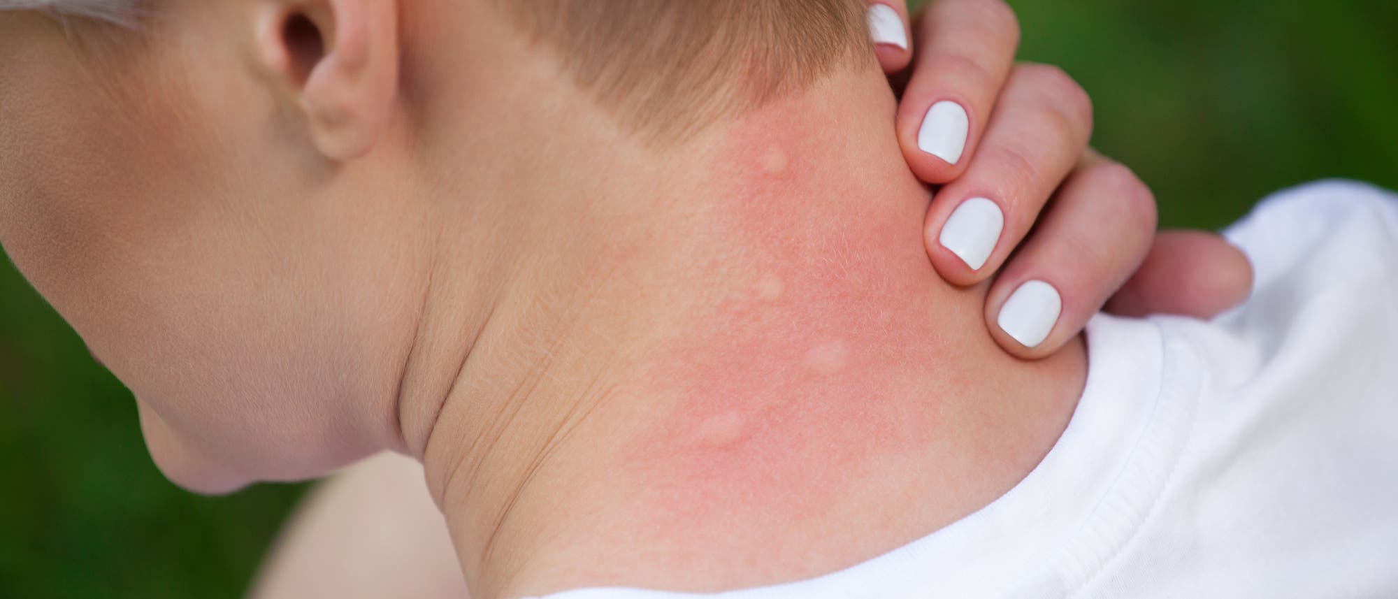 Nacken einer Frau mit mehreren Mückenstichen.