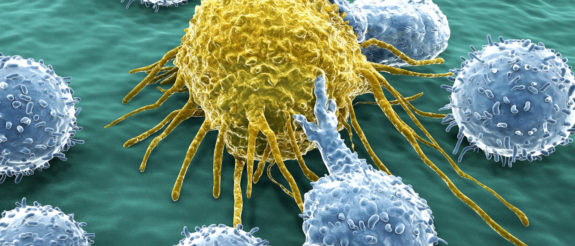 Menschliche T-Lymphozyten (blau) attackieren eine Krebszelle (gelb). Kolorierte Raster-Elektronen-Mikroskopische Aufnahme.