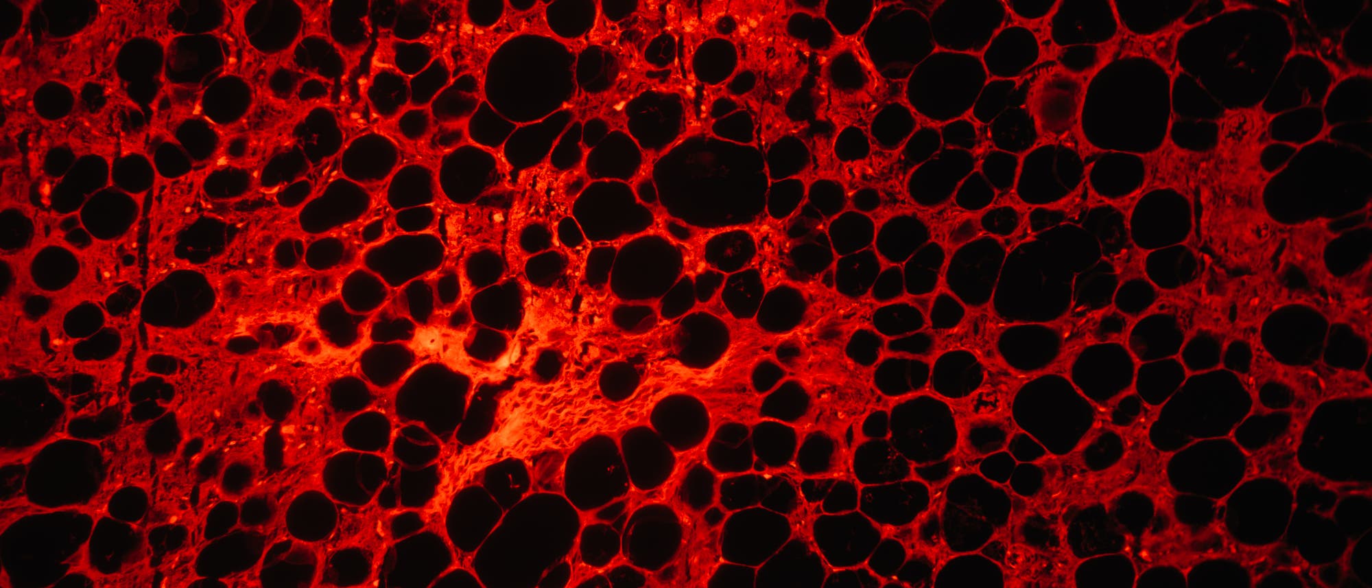 Im Bild zu sehen sind Liposarkomzellen, hier rot markiert durch Fluoreszenzfärbung. Im Bild zu sehen sind Liposarkomzellen, hier rot markiert durch Fluoreszenzfärbung.