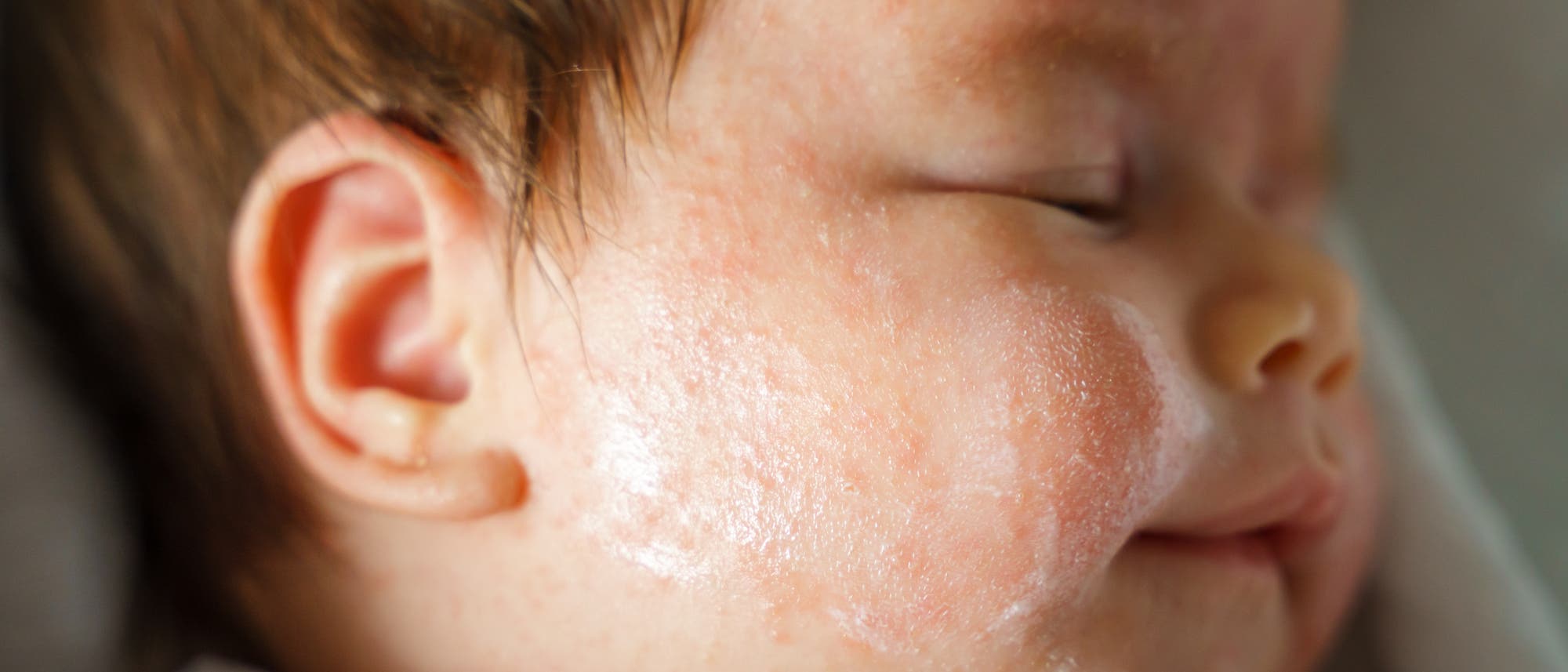 Ein schlafendes Baby liegt auf der Seite. Die Nahaufnahme zeigt das Gesicht des Babys mit geschlossenen Augen und einem sanften Ausdruck. Die Haut des Babys ist mit einer leichten Creme bedeckt. Das Bild vermittelt Ruhe und Geborgenheit.