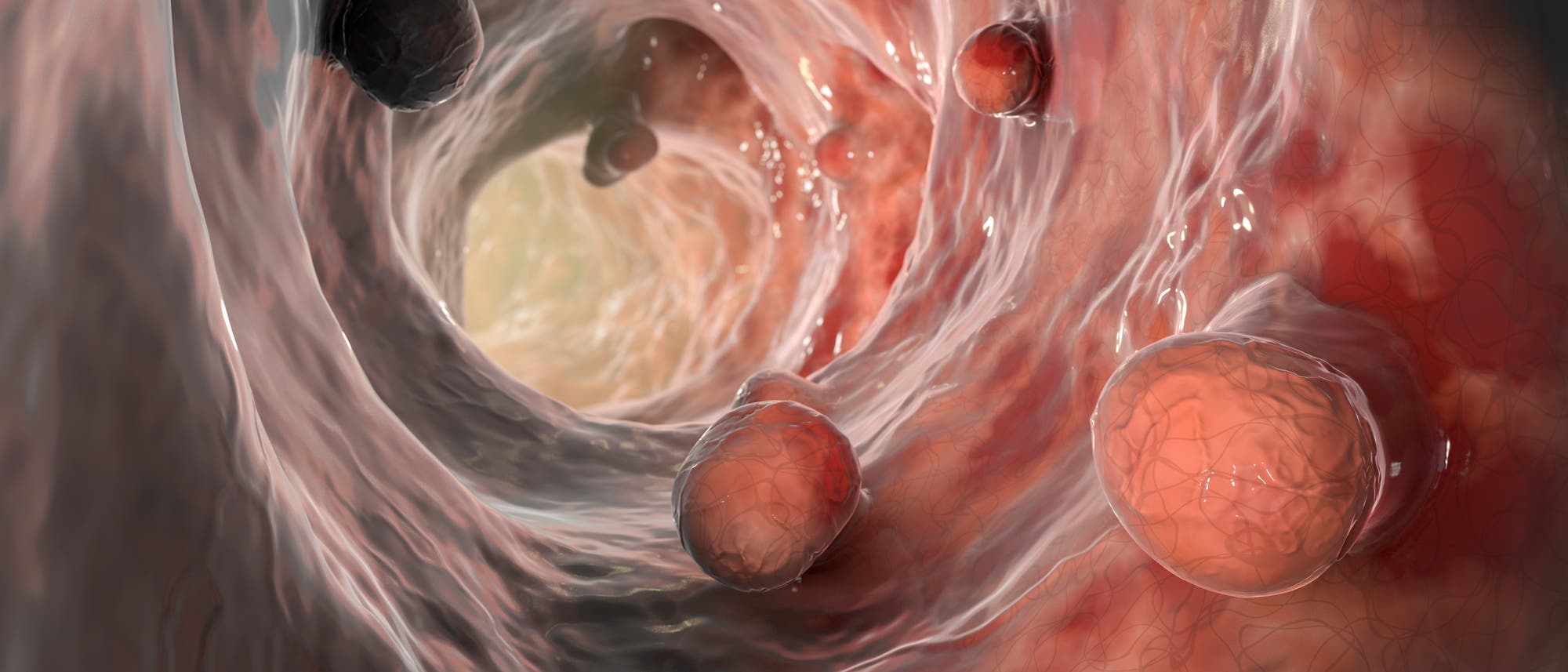 Eine detaillierte anatomische Illustration eines menschlichen Dickdarms, die mehrere Polypen zeigt. Die Polypen sind als runde, erhabene Strukturen an der Darmwand dargestellt. Die Darstellung hebt die Textur und Farbe der Darmwand hervor, um die Unterschiede zwischen gesundem Gewebe und den Polypen zu verdeutlichen. Diese Abbildung dient der Veranschaulichung von Polypen im Darm und deren potenzieller Bedeutung f&uuml;r die Gesundheit.