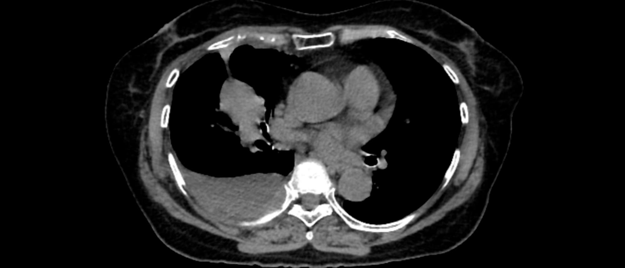 Ein CT-Scan des menschlichen Brustkorbs in Querschnittsansicht.