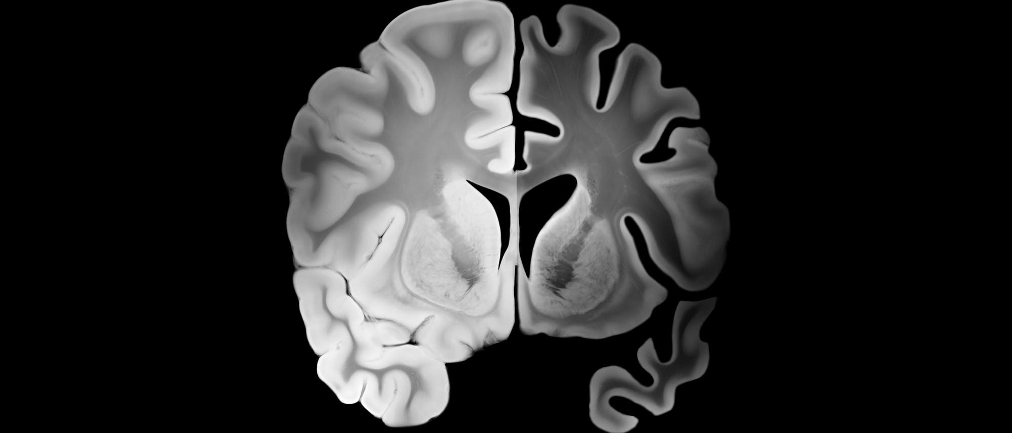 Querschnitt durch ein menschliches Gehirn, der die beiden Hemisphären zeigt. Die graue und die weiße Substanz sind deutlich sichtbar, ebenso wie die Furchen und Windungen der Großhirnrinde. Die Darstellung hebt die symmetrische Struktur und die Komplexität der Hirnoberfläche hervor. Querschnitt durch ein menschliches Gehirn, der die beiden Hemisphären zeigt. Die graue und die weiße Substanz sind deutlich sichtbar, ebenso wie die Furchen und Windungen der Großhirnrinde. Die Darstellung hebt die symmetrische Struktur und die Komplexität der Hirnoberfläche hervor.
