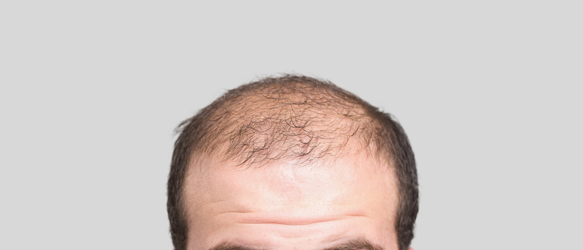 Mann mit Haarausfall 
