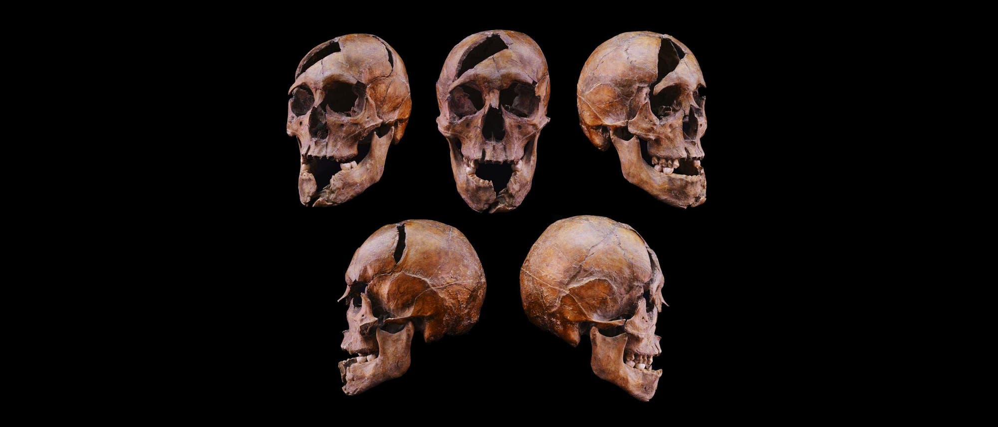 Ein wissenschaftliches Diagramm zeigt f&uuml;nf Ansichten eines menschlichen Sch&auml;dels vor einem schwarzen Hintergrund. Die Ansichten umfassen zwei seitliche, eine frontale und zwei diagonale Perspektiven. Der Sch&auml;del weist sichtbare Br&uuml;che und Verletzungen auf. Die Struktur der Sch&auml;delknochen und die Zahnanordnung sind deutlich erkennbar.