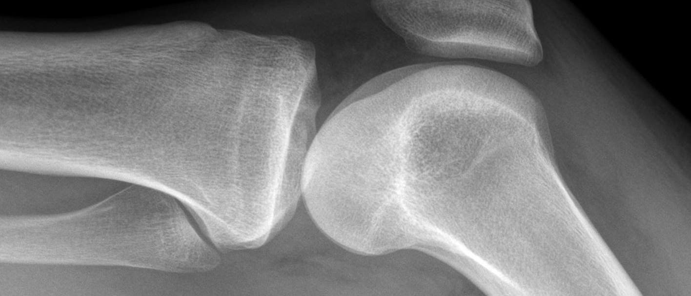 Kniegelenk im Röntgenbild