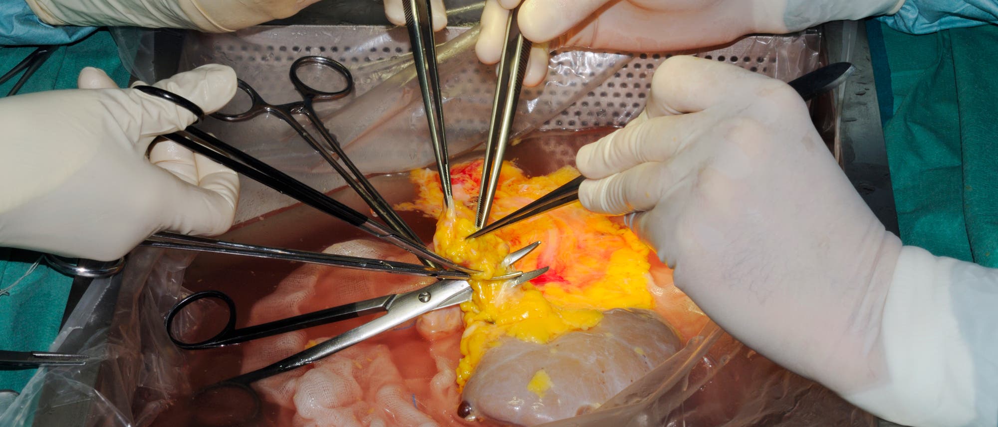 Ärzte bereiten eine Nierentransplantation vor