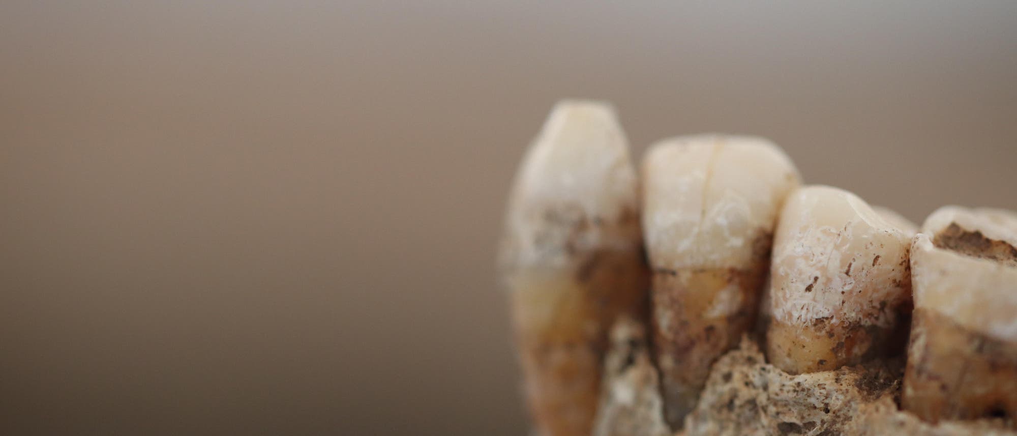 Ein Kieferfragment aus Italien mit Zahnstein