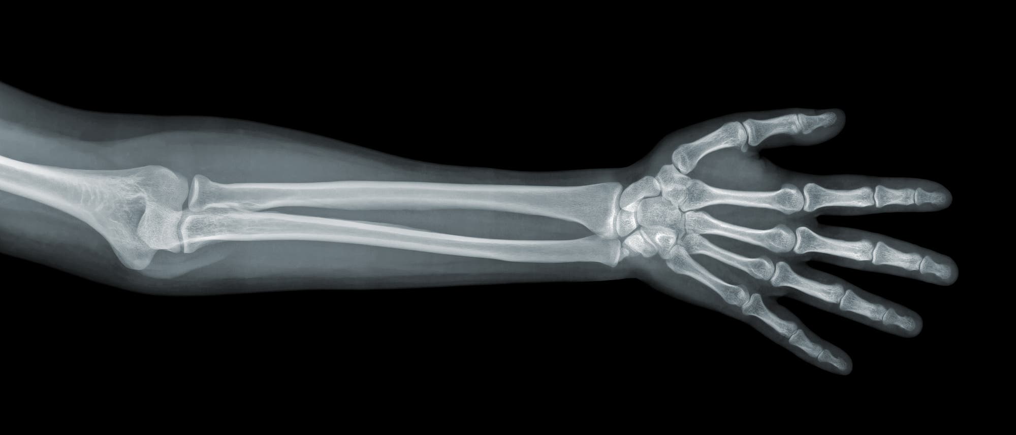 Arm und Hand im Röntgenbild