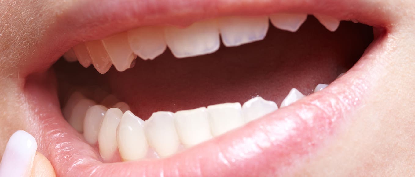 Frau mit Zahnfleischschmerzen