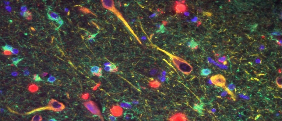 Rot markierte Gingipain-Enzyme zwischen Alzheimerneuronen