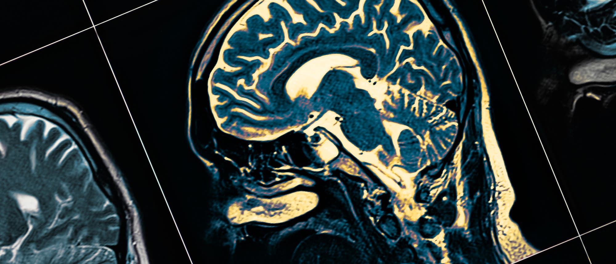 MRT-Bild vom Gehirn