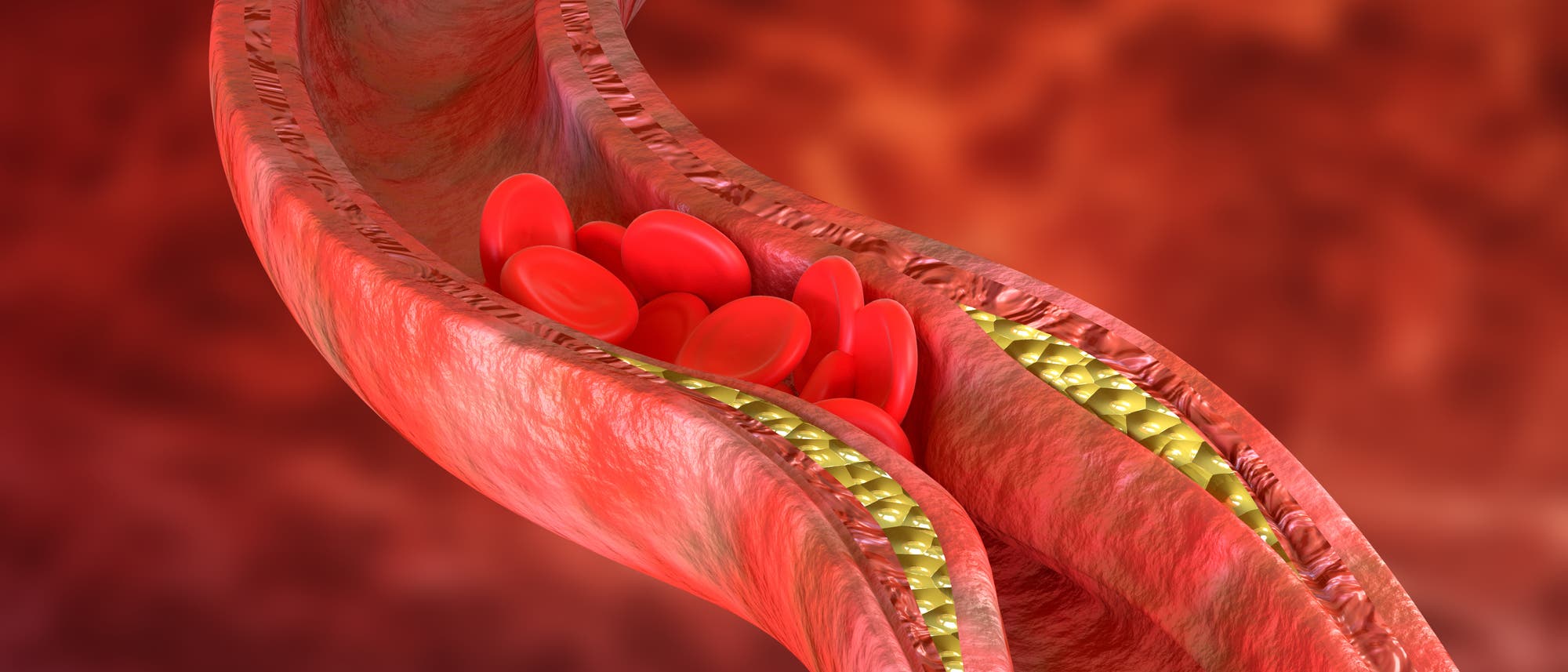 Symbolbild: an einem entzündlichen Plaque stauen sich rote Blutkörperchen.