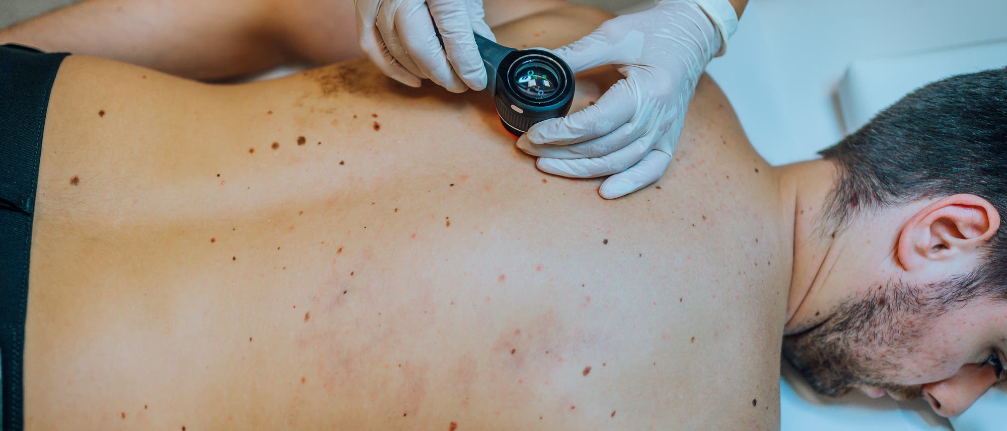 Ein Mann liegt oberkörperfrei auf dem Bauch auf einer Liege. Seine Pigmentflecken auf dem Rücken werden mit einem Dermatoskop untersucht. 
