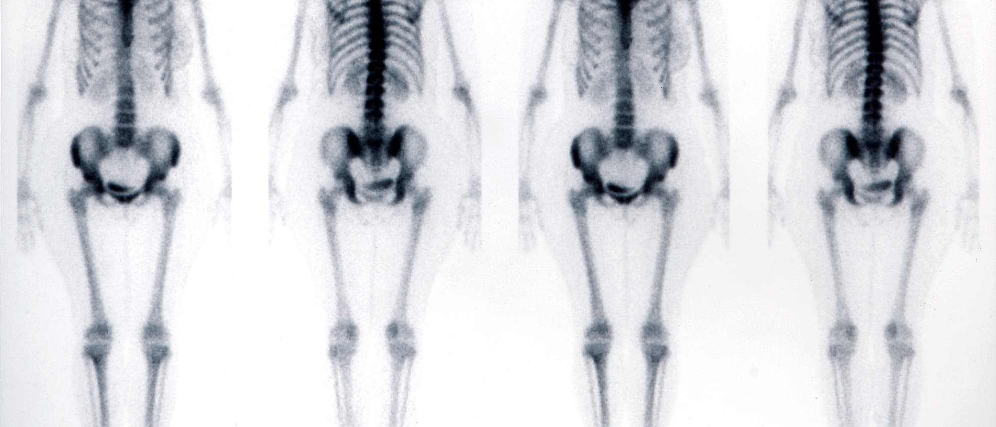 Mit der Skelettszintigrafie können aktive Veränderungen im Knochen nuklearmedizinisch festgestellt werden.