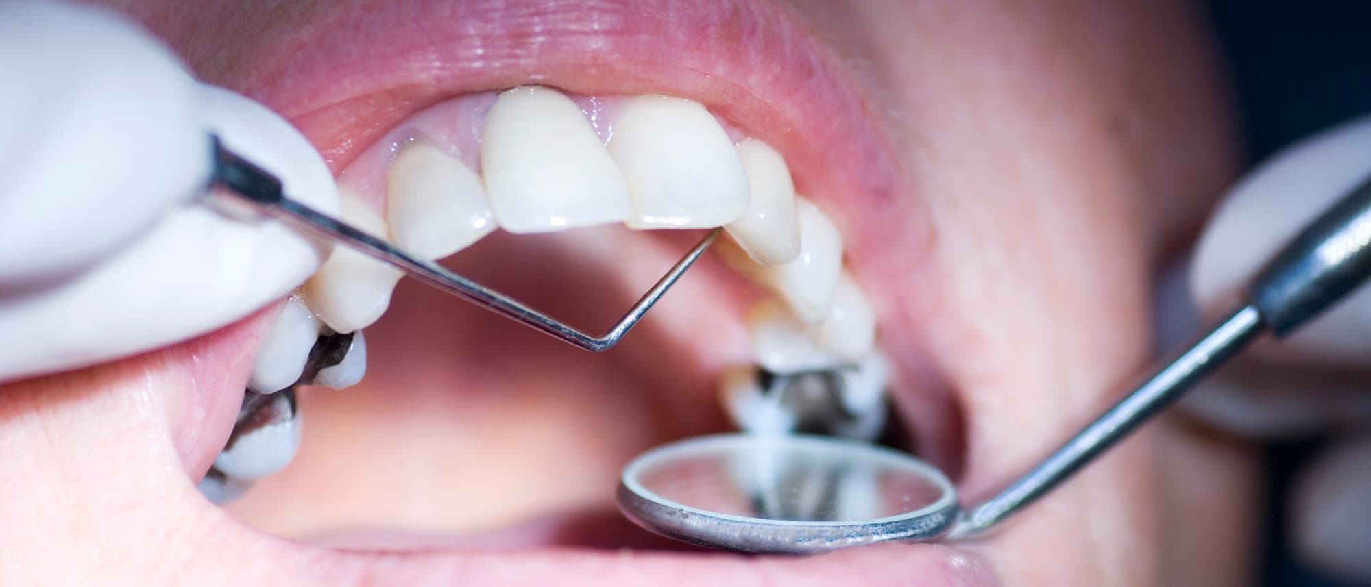 Geöffneter Mund während Zahnbehandlung