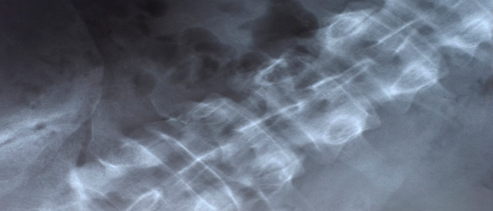 Röntgenaufnahme der Wirbelsäule