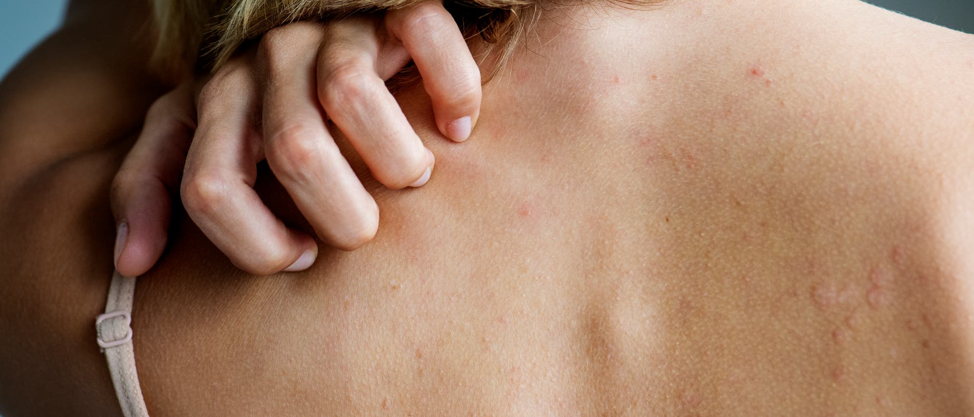Mit Hautausschlägen oder Juckreiz beginnen etliche Autoimmunkrankheiten. Oft trifft es Frauen.