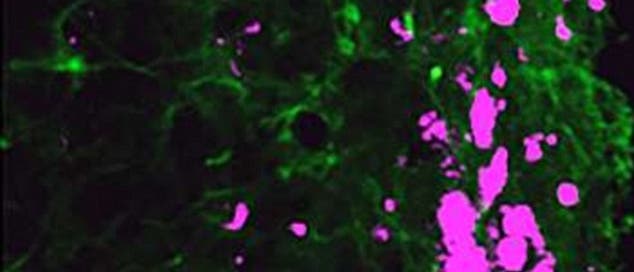 Umprogrammierte Stammzellen (grün) jagen und zerstören Glioblastom-Zellen (pink)