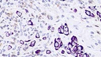 Lymphknoten-Sektion mit Immun- und Krebszellen
