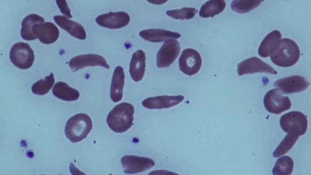 rote Blutkörperchen, Sichelzellanämie