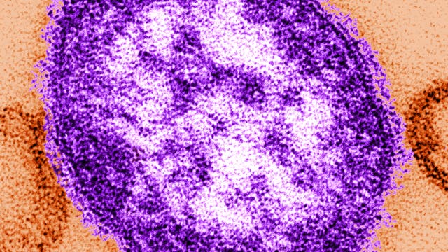 Eine undatierte Abbildung, die mit Hilfe eines Transmissionselektronenmikroskops gemacht wurde, zeigt Teile eines Masernvirus lila eingefärbt. 