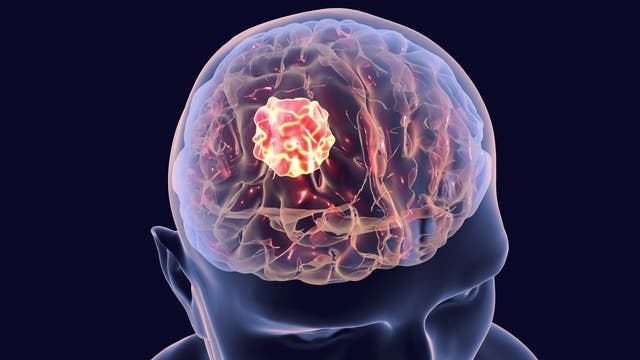 Illustration eines Hirntumors im Gehirn
