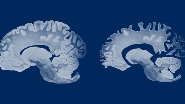 Zwei Querschnitte von Gehirnen, die die Abnahme des Hirnvolumens beim Auftreten von Alzheimer zeigen, links das Gehirn eines Gesunden und rechts das eines Erkrankten. Die Darstellung ist in Blautönen gehalten, um die Details der Gehirnanatomie zu betonen.