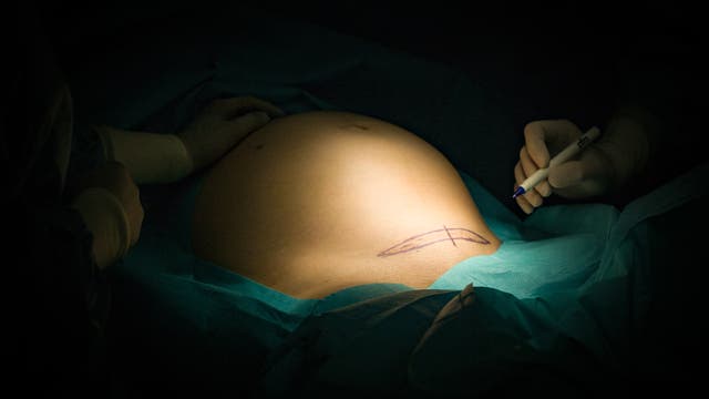 Eine schwangere Person liegt auf einem Operationstisch, der Bauch ist mit einem chirurgischen Tuch bedeckt. Zwei Hände in OP-Handschuhen sind sichtbar; eine hält einen Stift und zeichnet eine Markierung auf den Bauch. Die Szene ist in gedämpftem Licht gehalten, das den Bauch hervorhebt.