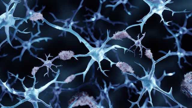 Illustration mit Nervenzellen, an denen sich verklumpte, stäbchenförmige Plaques abgelagert haben